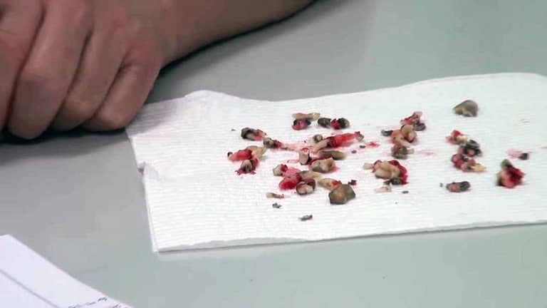 Screen capture from the video, showing the removed teeth of Wally, the Maltese Poodle.